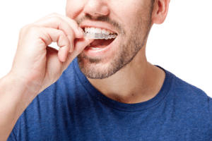 Close-up view of a man inserting a clear aligner onto his upper arch.